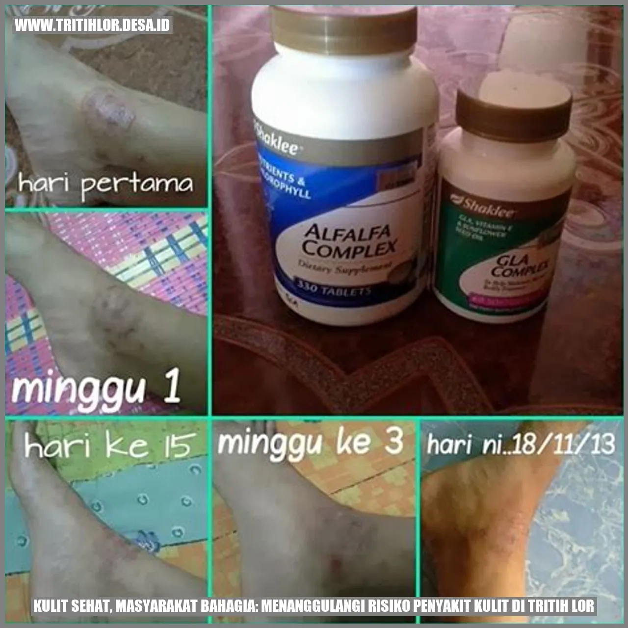 Kulit Sehat, Masyarakat Bahagia: Menanggulangi Risiko Penyakit Kulit di Tritih Lor